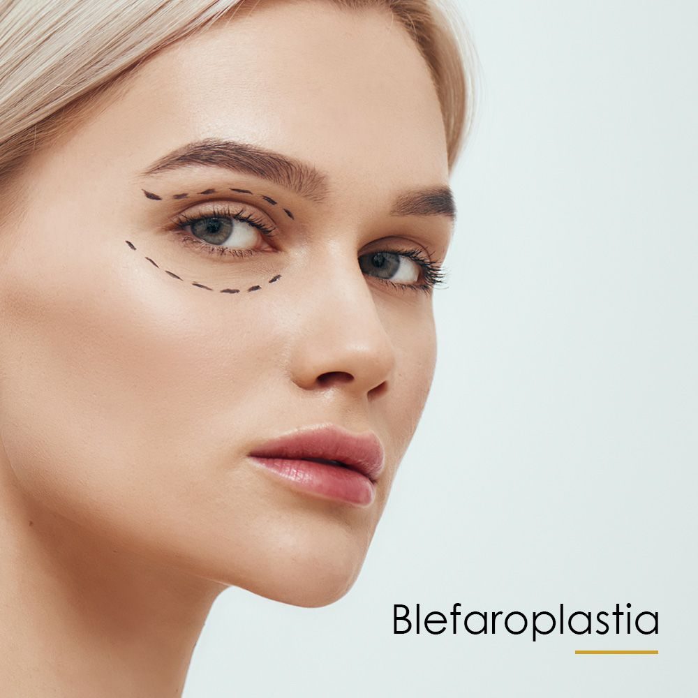 Blefaroplastia