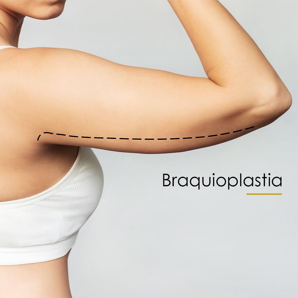 Braquioplastia_