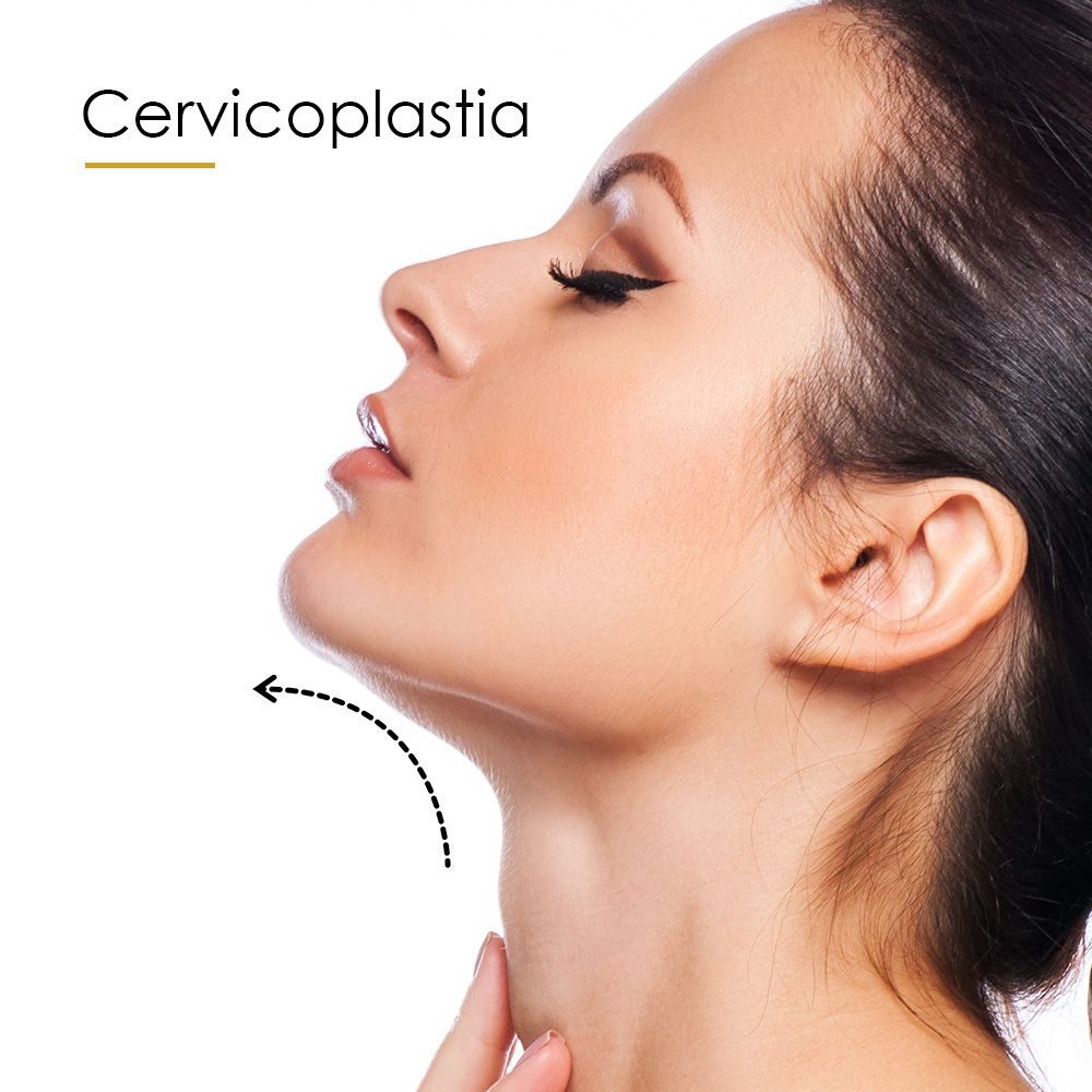 Cervicoplastia_