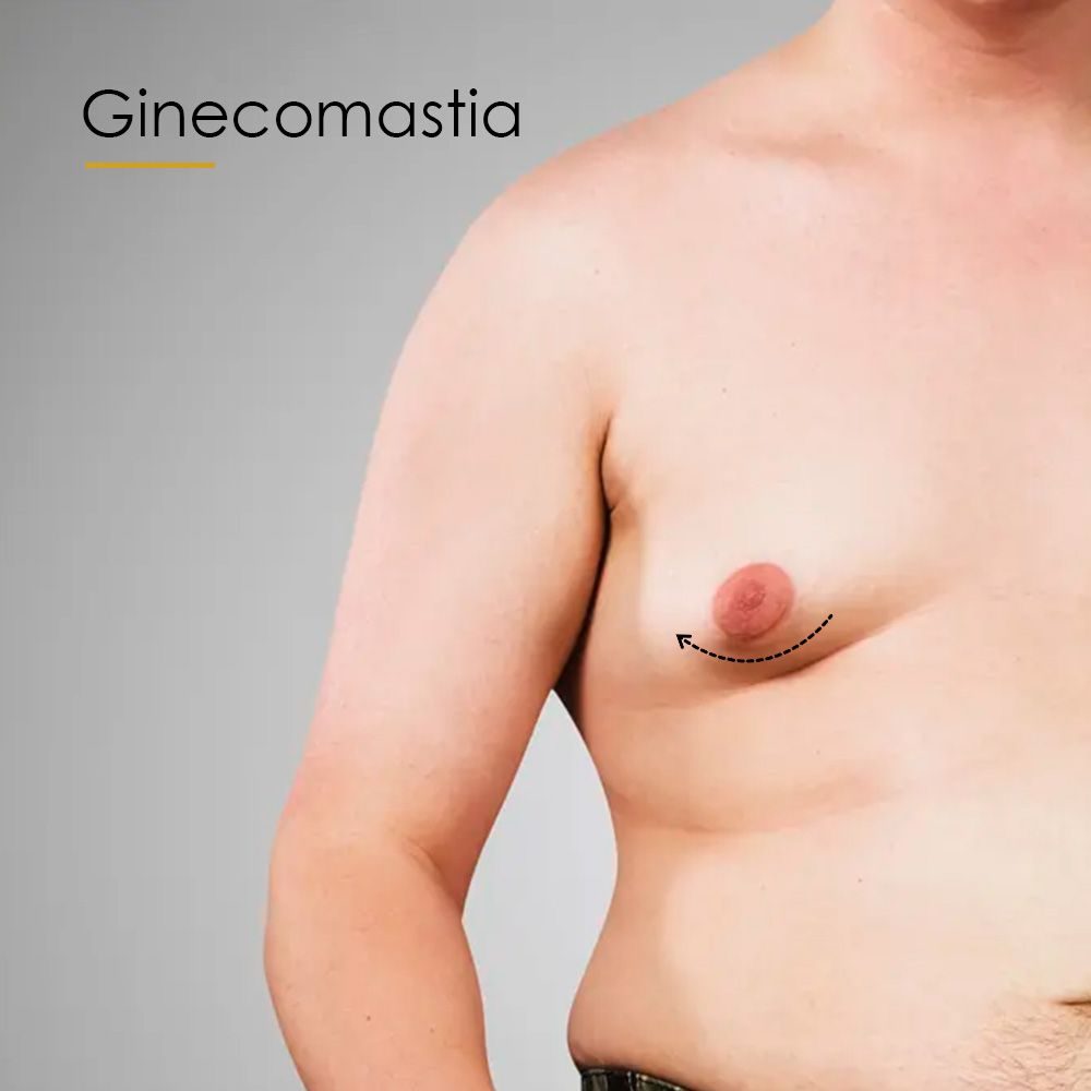 Ginecomastia